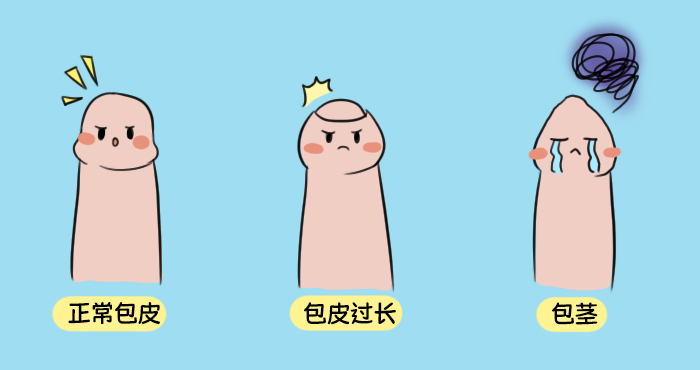 包皮有必要割吗