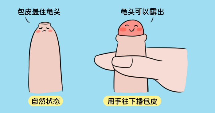 包皮过长