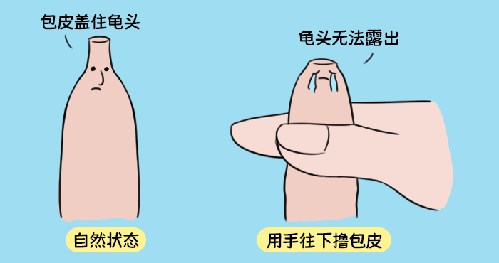 包茎