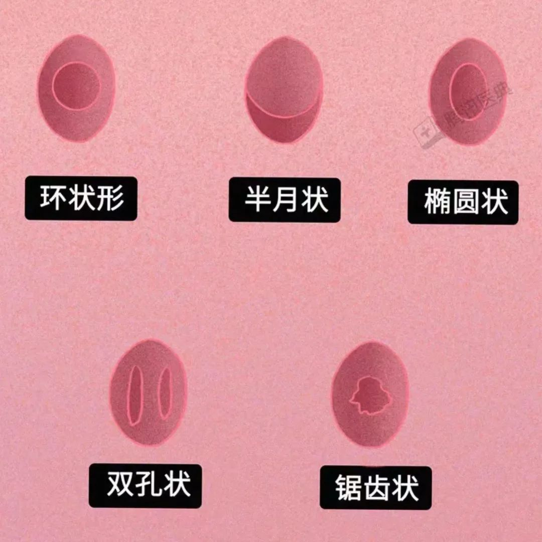很多人对“处女膜”存在误解,认为它就像窗户纸一样,是一层完好封闭的膜,一捅就破。事实上,并非如此…