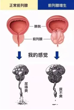这类表现很可能是前列腺增生的&ldquo;预警信号&rdquo;。 前列腺增生，医学上称为良性前列腺增生(BPH)，过去&hellip;