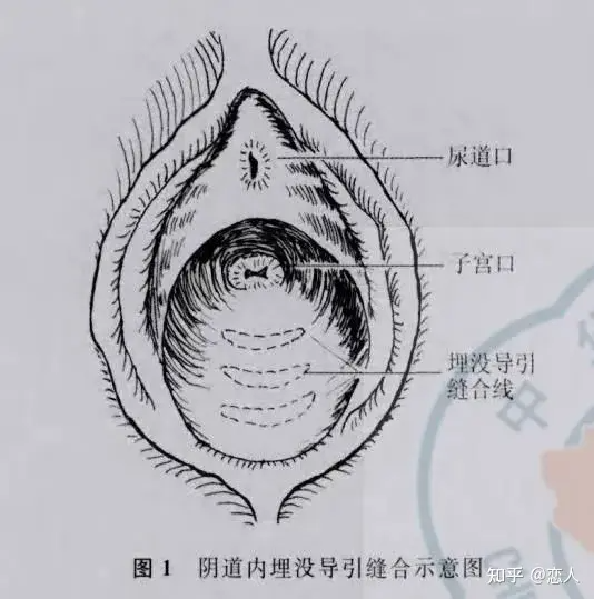 埋线