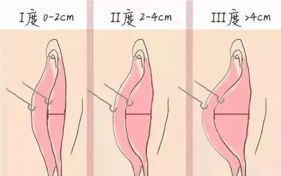 将小Y唇肥大分为3型
