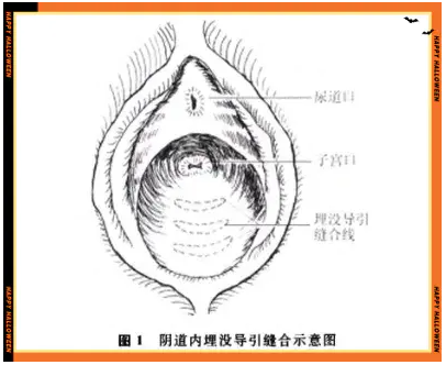 私处埋线、丁丁镶珠，真的能提升房事愉悦吗
