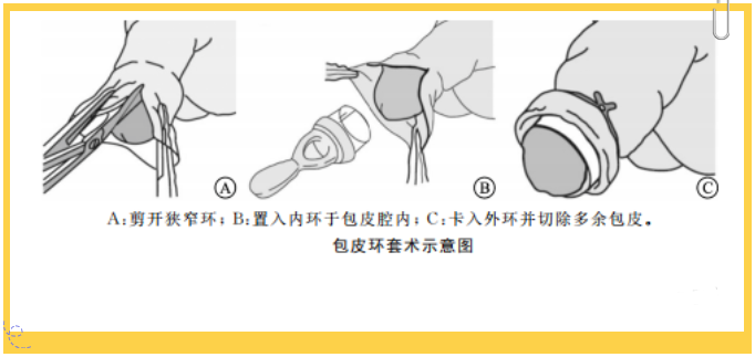 包度环套切术