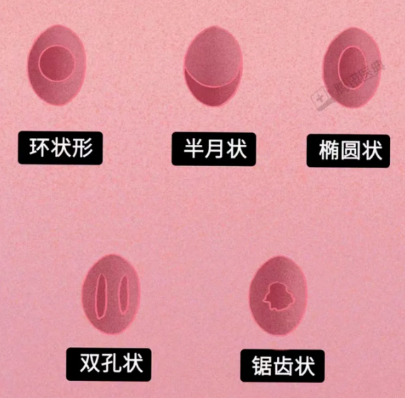图片来源:腾讯医典