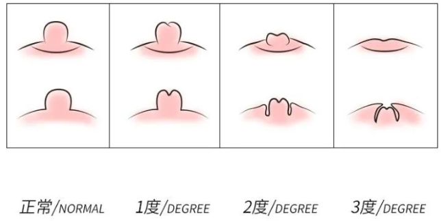 乳头内陷