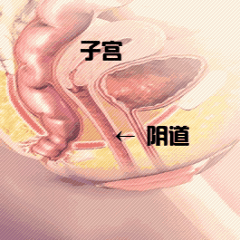 (注意箭头,盆底肌无力时,V道跟着松弛)