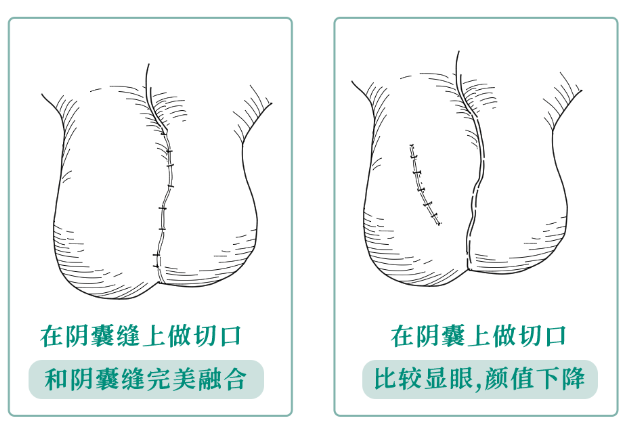 为什么男生的蛋蛋中间会有条缝!