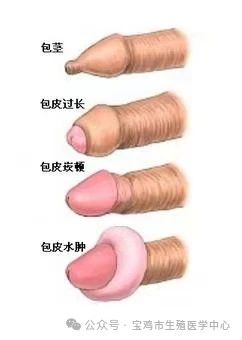 包皮过长性生活有没有影响