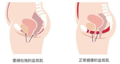产后漏尿？小兄弟不给力？凯格尔运动练起来！