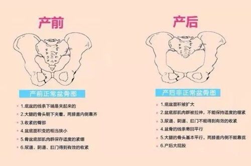 盆骨修复有必要吗？图文详解