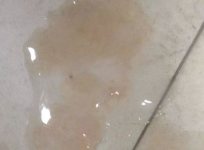 射精有血是什么原因引起