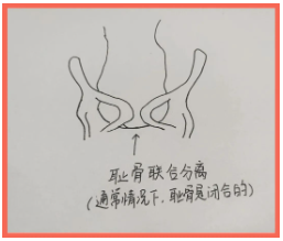 耻骨联合分离
