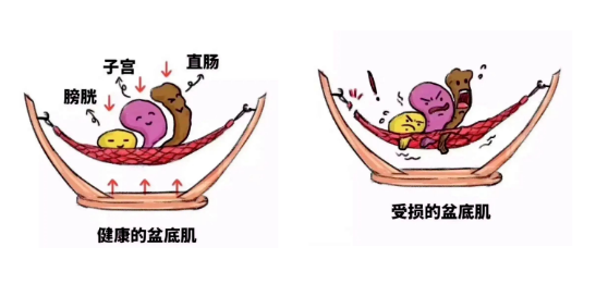 你以为是胖了？其实是盆底肌在警告