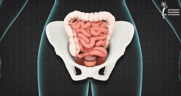 图源:Continence Foundation of Australia