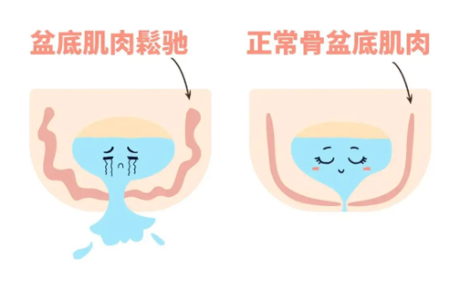 打个喷嚏就漏尿，还有得救吗？