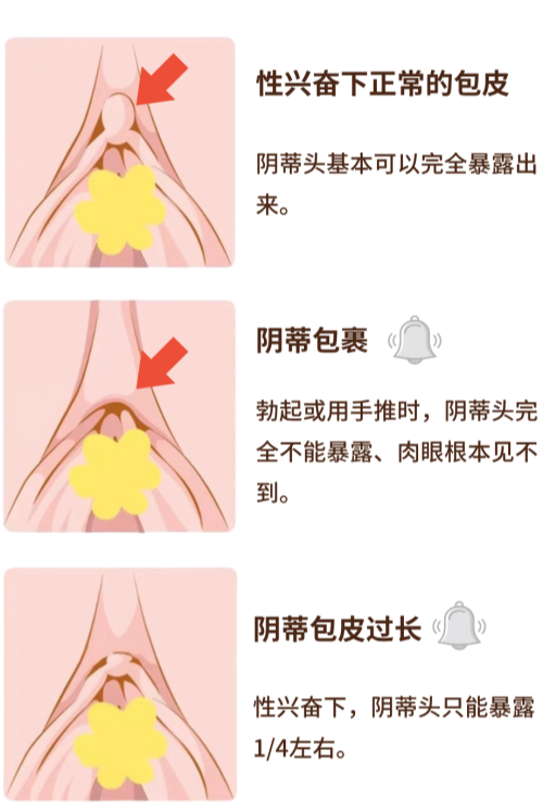 女生也有包皮?性生活没感觉可能是因为它过长