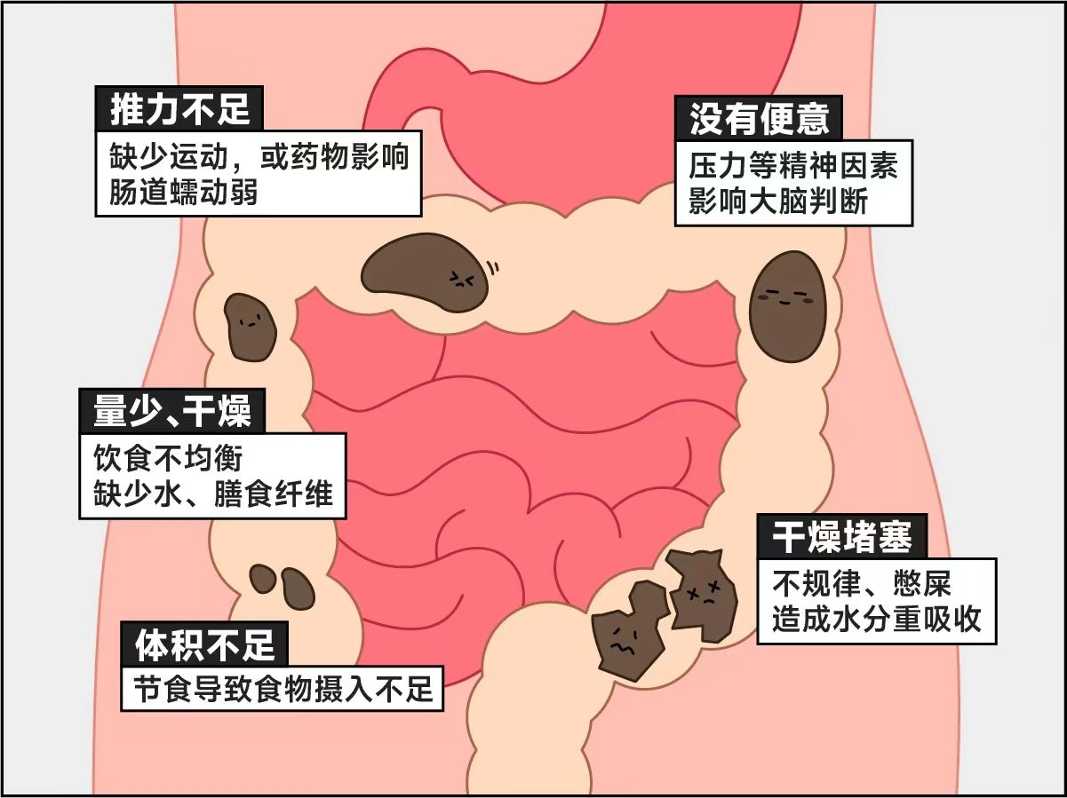 不算,一星期能拉3次,已经很正常了! 要达到便秘的标准,排便次数减少,得少到小于3次/周。 相比次数,这些症状更值得关注…
