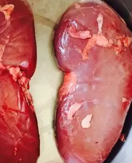 肝硬化可以服用西地那非吗