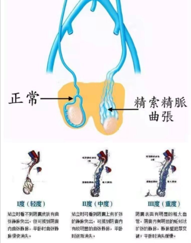 备孕总失败？90%男生都忽略的不育隐形杀手！精索静脉曲张为什么会影响生育？