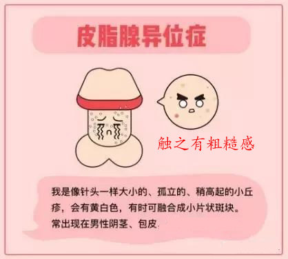 丁丁一圈小珍珠是病吗?夫妻必看的私处辨别指南