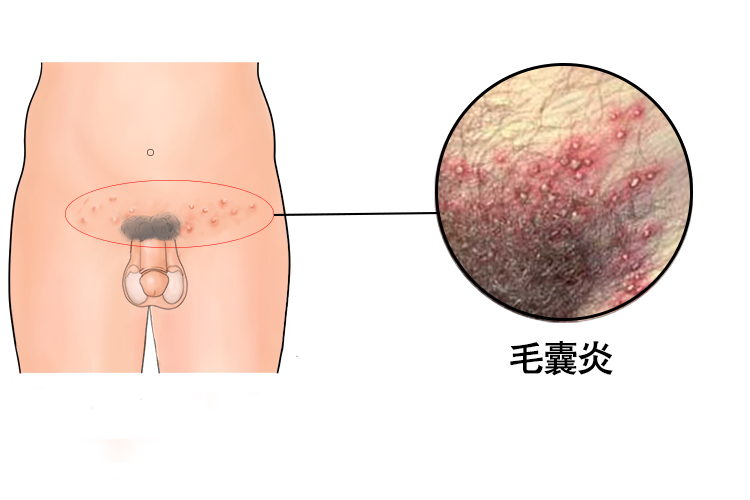丁丁一圈小珍珠是病吗?夫妻必看的私处辨别指南