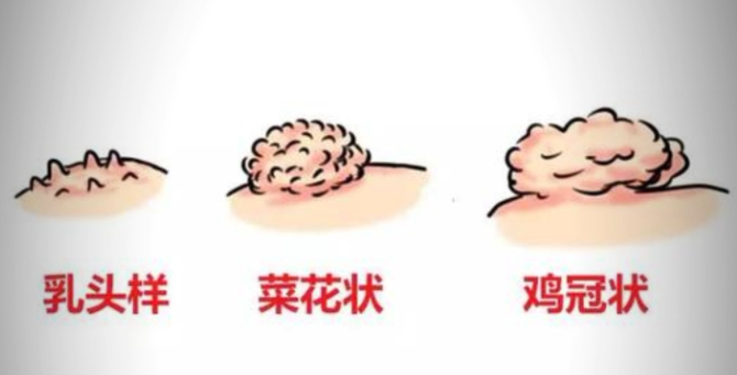 丁丁一圈小珍珠是病吗?夫妻必看的私处辨别指南